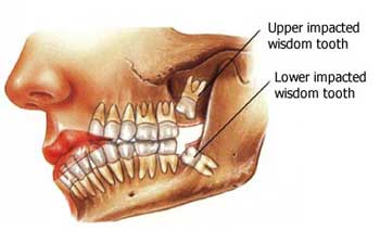 Is it wise to remove wisdom teeth